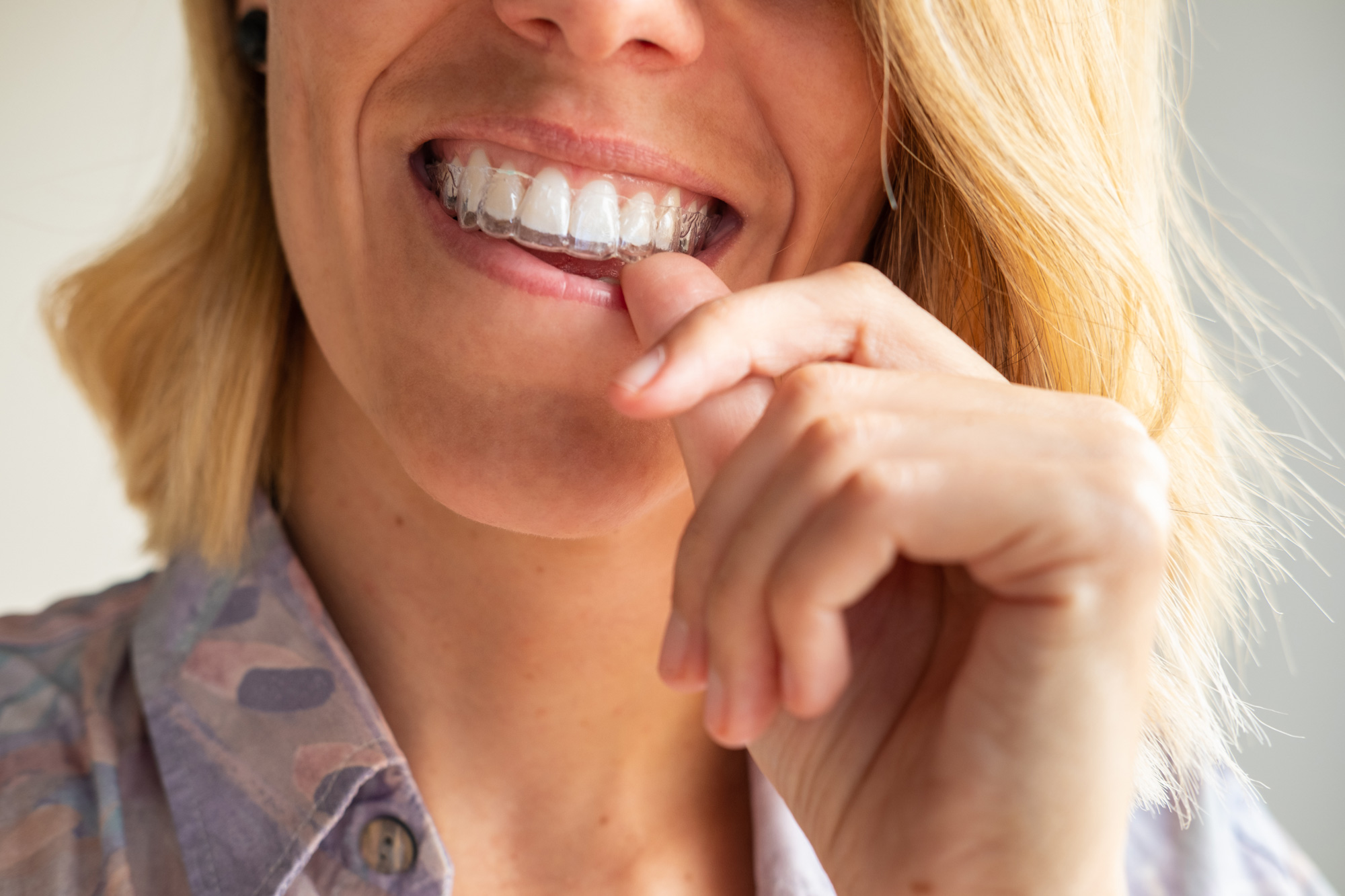 invisible braces
